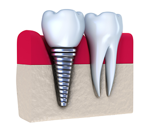 illustration of dental implant in gum next to real tooth Casa Grande, AZ dental implants